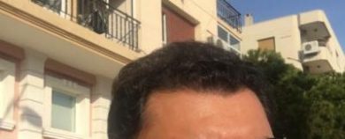 dr-koray-erdogan-hair-transplant (23)