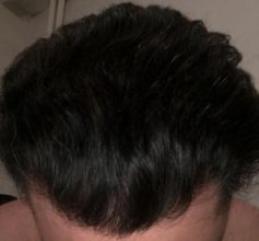 dr-koray-erdogan-hair-transplant (26)
