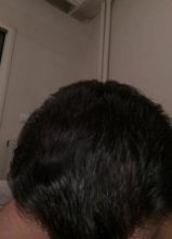 dr-koray-erdogan-hair-transplant (27)