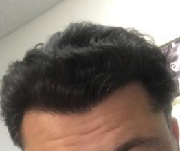 dr-koray-erdogan-hair-transplant (28)