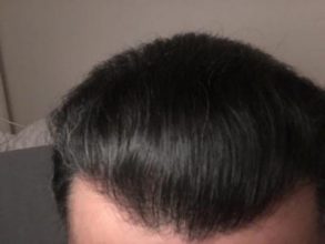 dr-koray-erdogan-hair-transplant (29)