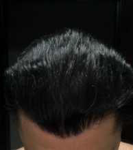 dr-koray-erdogan-hair-transplant (3)