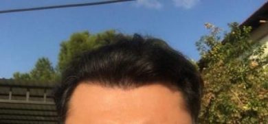 dr-koray-erdogan-hair-transplant (30)