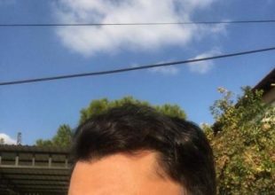 dr-koray-erdogan-hair-transplant (31)