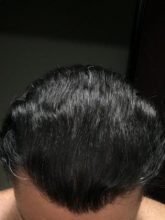 dr-koray-erdogan-hair-transplant (4)