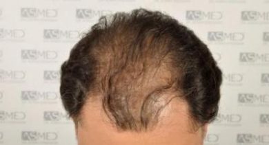 dr-koray-erdogan-hair-transplant (5)