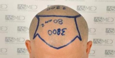 dr-koray-erdogan-hair-transplant (7)