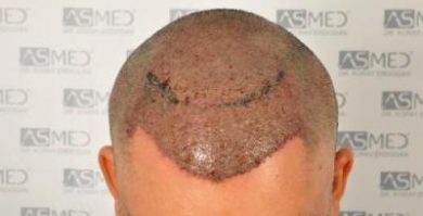 dr-koray-erdogan-hair-transplant (8)