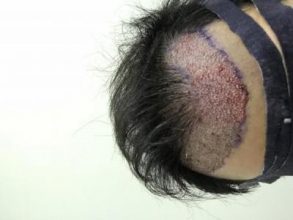 dr-kul-hair-transplant-result (1)
