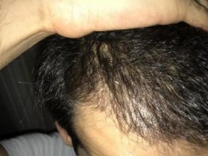 dr-kul-hair-transplant-result (10)