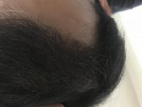 dr-kul-hair-transplant-result (12)