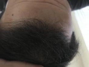 dr-kul-hair-transplant-result (13)