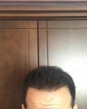 dr-kul-hair-transplant-result (14)