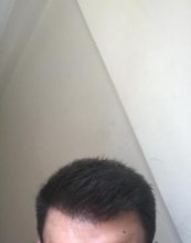 dr-kul-hair-transplant-result (17)