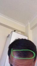 dr-kul-hair-transplant-result (18)