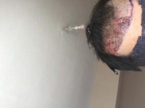 dr-kul-hair-transplant-result (19)
