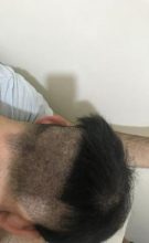 dr-kul-hair-transplant-result (2)