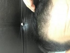 dr-kul-hair-transplant-result (5)