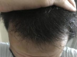dr-kul-hair-transplant-result (7)