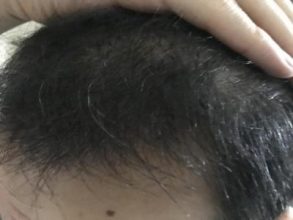 dr-kul-hair-transplant-result (8)