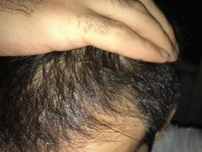 dr-kul-hair-transplant-result (9)