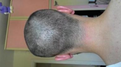 hair-transplant-line (10)