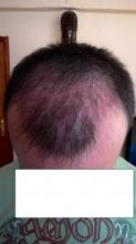 hair-transplant-line (11)