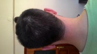 hair-transplant-line (12)