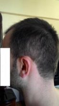 hair-transplant-line (13)
