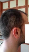 hair-transplant-line (14)