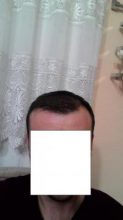 hair-transplant-line (15)