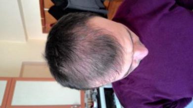 hair-transplant-line (16)