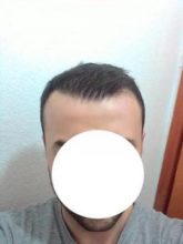 hair-transplant-line (17)