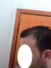 hair-transplant-line (19)