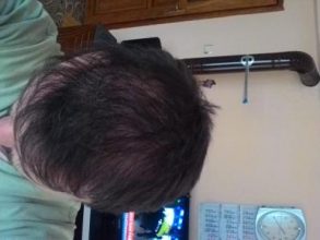 hair-transplant-line (20)
