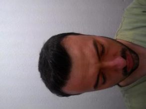 hair-transplant-line (21)