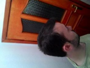 hair-transplant-line (24)