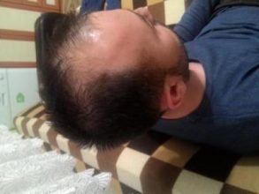 hair-transplant-line (4)