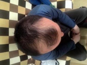 hair-transplant-line (5)