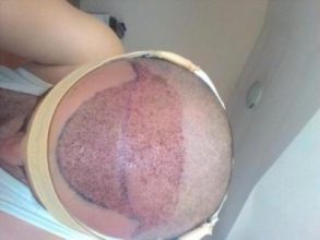 hair-transplant-line (6)