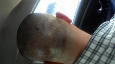 hair-transplant-line (7)