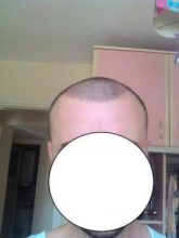 hair-transplant-line (8)