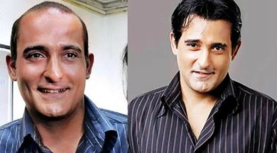 akshaye-khanna-hair-transplant