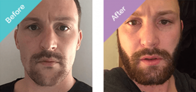 Before-after-Beard-Transplant-Turkey-hair-transplant