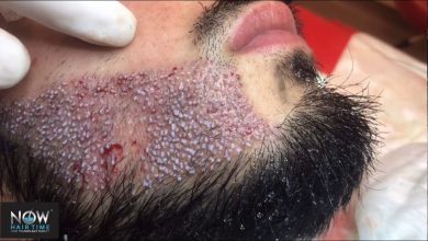 beard-transplant