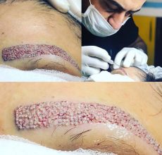 eyebrow-transplantation