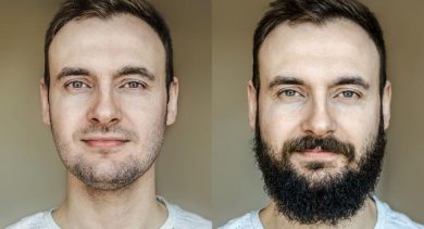 facial-beard-transplants