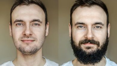 facial-beard-transplants