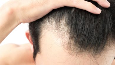 what is-shock-hair-loss