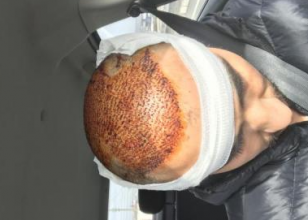 4000-grafts-hair-transplant-result-1